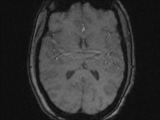 Bilateral carotid body tumors and right glomus jugulare tumor (Radiopaedia 20024-20060 Axial MRA 353).jpg