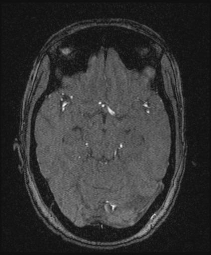 Bilateral carotid body tumors and right glomus jugulare tumor (Radiopaedia 20024-20060 Axial MRA 75).jpg