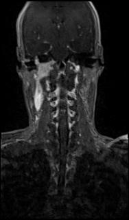 Bilateral carotid body tumors and right glomus jugulare tumor (Radiopaedia 20024-20060 MRA 43).jpg