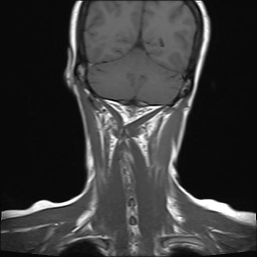 File:Bilateral carotid body tumors and right jugular paraganglioma (Radiopaedia 20024-20060 Coronal 21).jpg