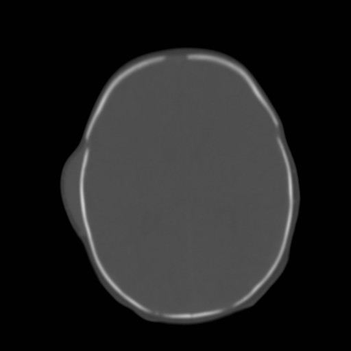 File:Bilateral cephalohematomas and subdural hematomas (Radiopaedia 26778-26929 Axial bone window 17).jpg