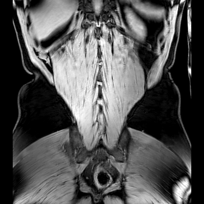 Bilateral conjoined nerve roots at different levels (Radiopaedia 73312-84063 Coronal WE 50).jpg