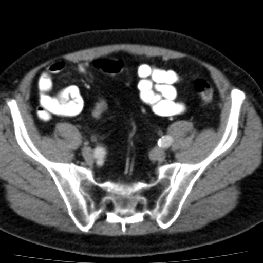 File:Bilateral direct inguinal herniae (Radiopaedia 17016-16719 B 1).jpg