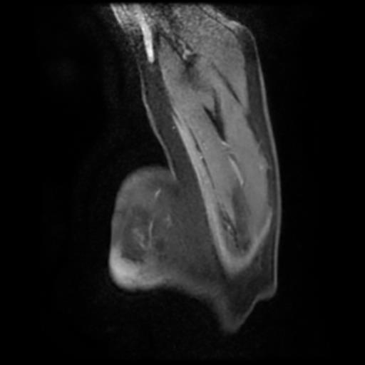 Bilateral elastofibromas dorsi (Radiopaedia 90158-107344 H 14).jpg