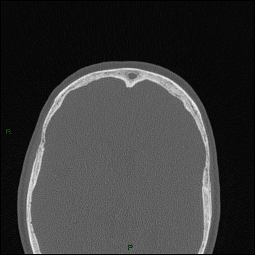 Bilateral frontal mucoceles (Radiopaedia 82352-96454 Axial bone window 65).jpg