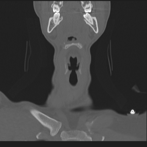 Bilateral locked facets (Radiopaedia 33850-35016 Coronal bone window 14).png