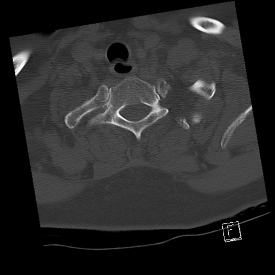 Bilateral occipital condyle fractures (type 3) (Radiopaedia 87672-104086 Axial bone window 71).jpg