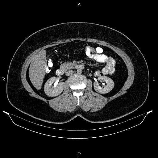 Bilateral ovarian dermoid cysts (Radiopaedia 85785-101603 Axial C+ delayed 30).jpg