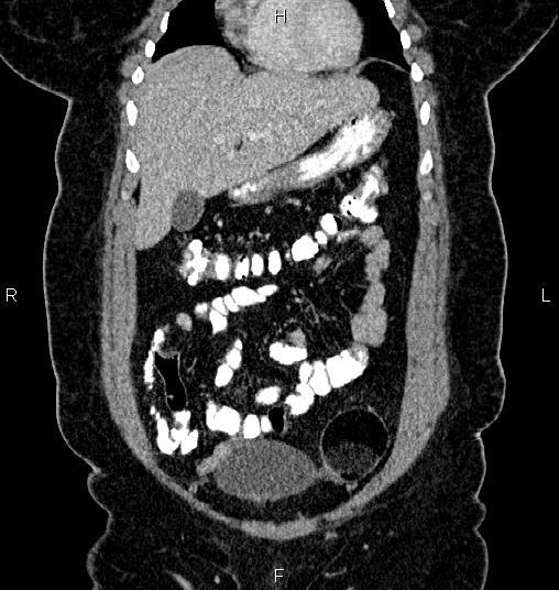 Bilateral ovarian dermoid cysts (Radiopaedia 85785-101603 C 10).jpg