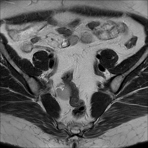 File:Bilateral ovarian dermoid cysts (Radiopaedia 90152-107338 Axial T2 7).jpg