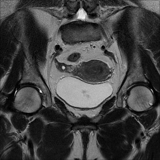 File:Bilateral ovarian dermoid cysts (Radiopaedia 90152-107338 Coronal T2 14).jpg