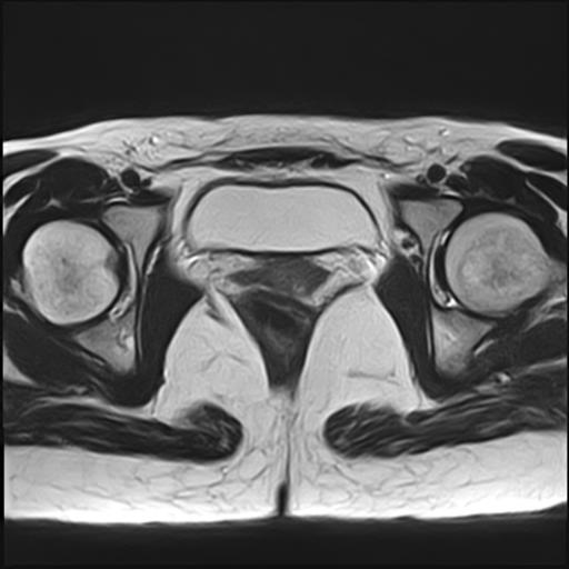 File:Bilateral ovarian endometriomas (Radiopaedia 87085-103347 Axial T2 17).jpg