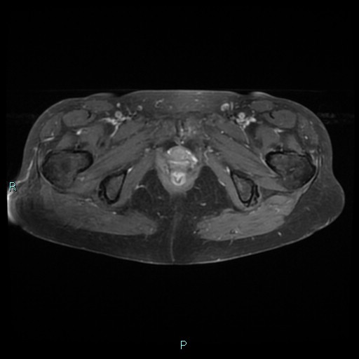 File:Bilateral ovarian fibroma (Radiopaedia 44568-48293 Axial T1 C+ fat sat 26).jpg