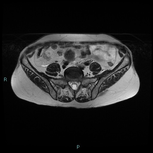 File:Bilateral ovarian fibroma (Radiopaedia 44568-48293 Axial T2 3).jpg