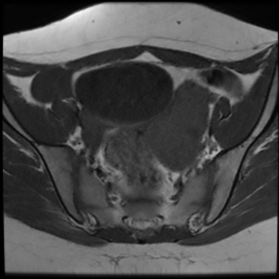 File:Bilateral ovarian fibrothecomas - adolescent (Radiopaedia 86604-102707 Axial T1 12).jpg