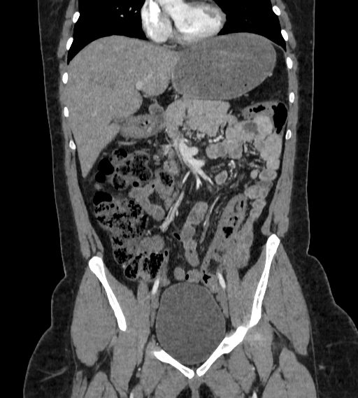 File:Bilateral ovarian mature cystic teratomas (Radiopaedia 79373-92457 B 22).jpg