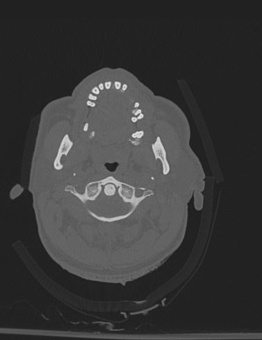 Bilateral perched facet joint (Radiopaedia 63149-71669 Axial bone window 1).jpg