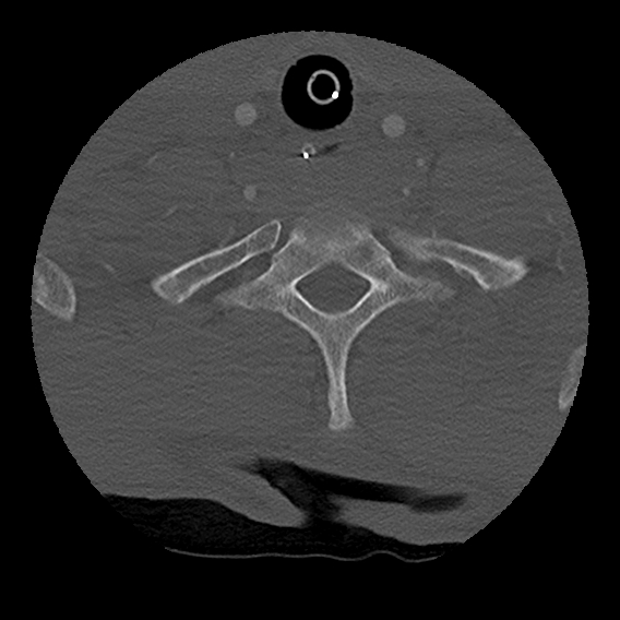 Bilateral perched facets with cord injury (Radiopaedia 45587-49713 Axial bone window 92).jpg