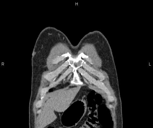 Bilateral pulmonary AVM (Radiopaedia 83134-97505 C 8).jpg