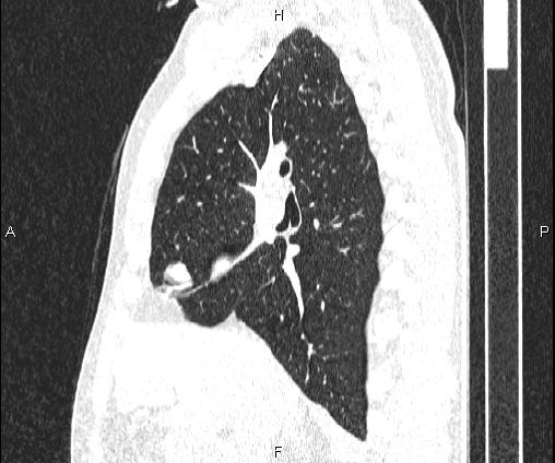 File:Bilateral pulmonary AVM (Radiopaedia 83134-97505 Sagittal lung window 50).jpg