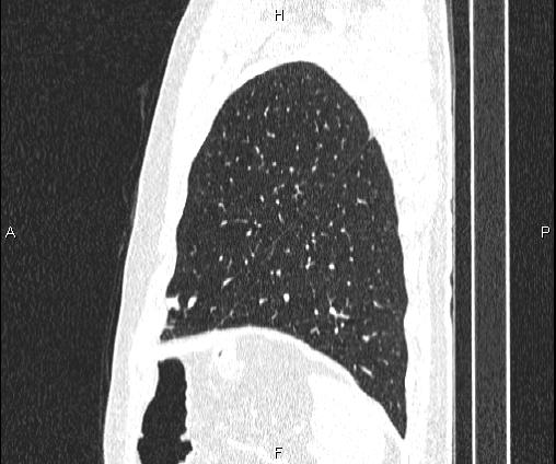 Bilateral pulmonary AVM (Radiopaedia 83134-97505 Sagittal lung window 93).jpg