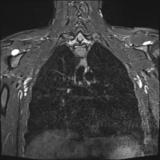 File:Bilateral spinoglenoid notch ganglion cysts (Radiopaedia 29577-30082 Coronal STIR 17).jpg