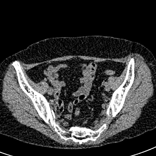 Bilateral staghorn calculi (Radiopaedia 59475-66842 Axial non-contrast 66).jpg