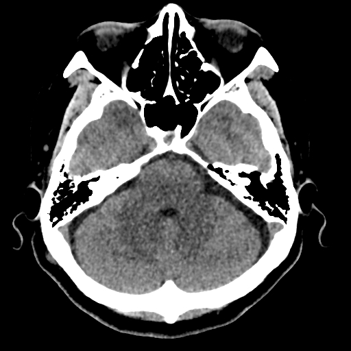 Bilateral subacute subdural hematoma (Radiopaedia 69240-79018 Axial non-contrast 13).jpg