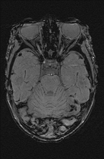 Bilateral subdural hemorrhage and parietal skull fracture (Radiopaedia 26058-26190 Axial SWI 21).png