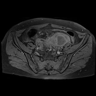 Bilateral tubo-ovarian abscesses (Radiopaedia 58635-65829 Axial T1 fat sat 11).jpg