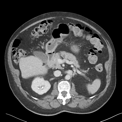 File:Bladder papillary urothelial carcinoma (Radiopaedia 48119-52951 Axial 17).png