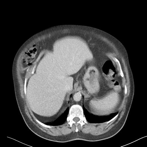 File:Bladder papillary urothelial carcinoma (Radiopaedia 48119-52951 Axial 7).png