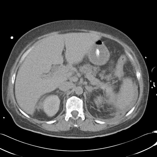 Bladder rupture post renal biopsy (Radiopaedia 30863-31572 Axial non-contrast 28).jpg