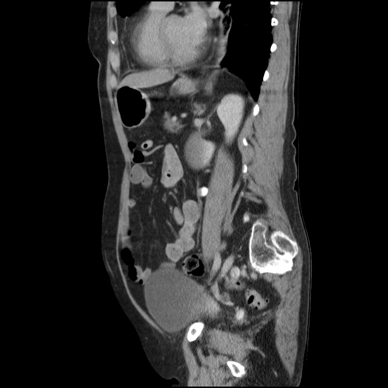 Bladder tumor detected on trauma CT (Radiopaedia 51809-57609 E 27).jpg
