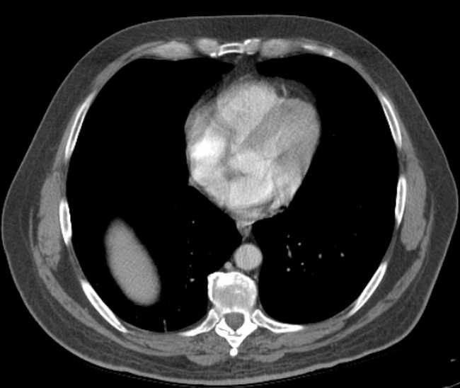 Bleeding duodenal ulcer and adenomyomatosis of gallbladder (Radiopaedia 61834-69861 A 2).jpg