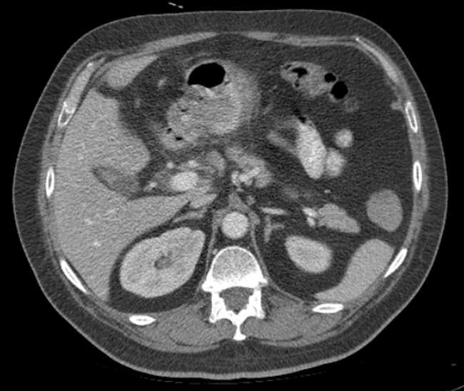 File:Bleeding duodenal ulcer and adenomyomatosis of gallbladder (Radiopaedia 61834-69861 A 32).jpg