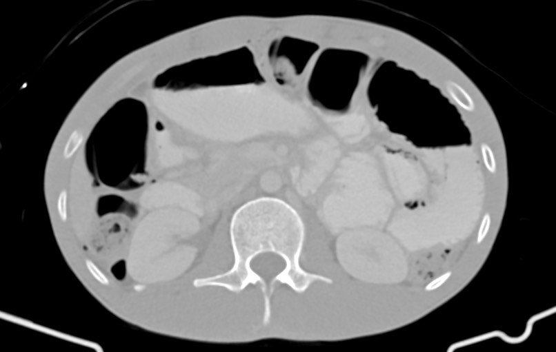 Blunt injury to the small bowel (Radiopaedia 74953-85987 Axial Wide 31).jpg