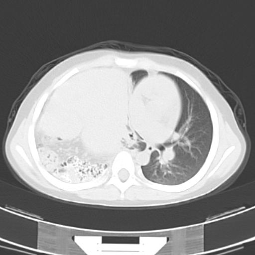 File:Bochdalek diaphragmatic hernia (Radiopaedia 38866-41059 Axial lung window 12).jpg