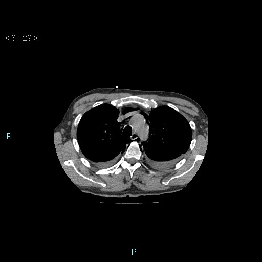 Boerhaave syndrome (Radiopaedia 27683-27897 Axial non-contrast 29).jpg