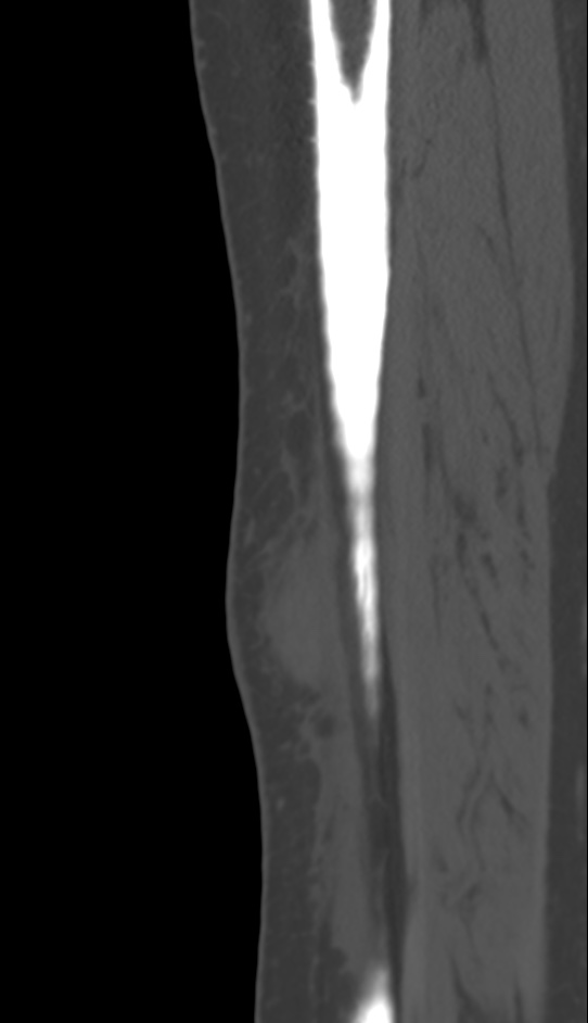Bone metastasis - tibia (Radiopaedia 57665-64609 Sagittal bone window 38).jpg