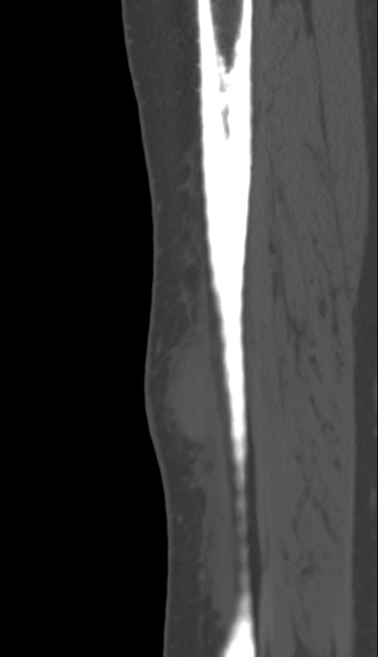 Bone metastasis - tibia (Radiopaedia 57665-64609 Sagittal bone window 40).jpg
