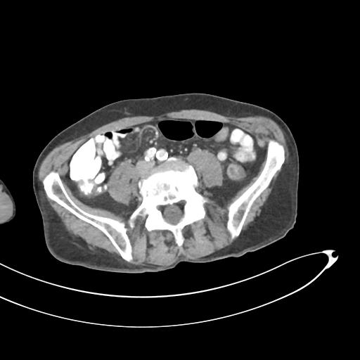 Bone metastasis from squamous cell carcinoma (Radiopaedia 30133-30730 B 48).jpg