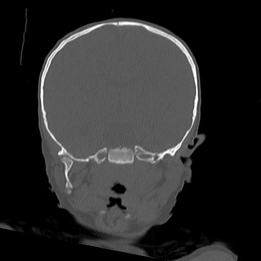 File:Bony atresia of the right external auditory canal (Radiopaedia 27916-28156 Coronal bone window 16).jpg