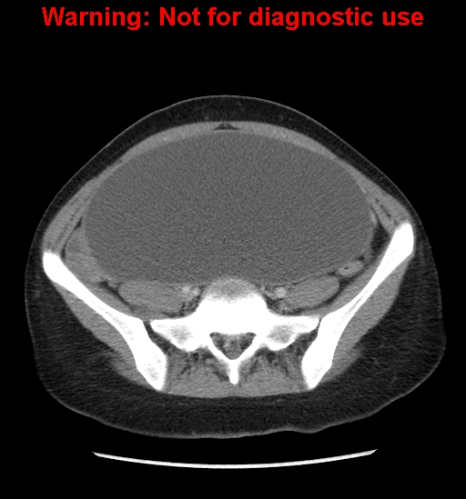Borderline mucinous cystadenoma of ovary (Radiopaedia 25586-25767 A 68).jpg