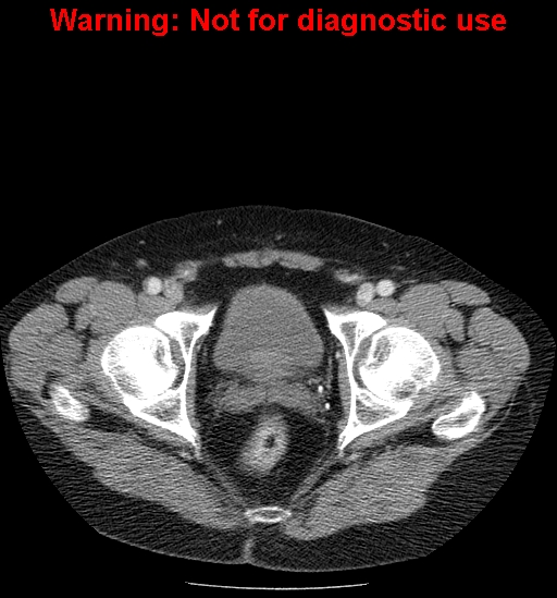 File:Bosniak renal cyst - type IV (Radiopaedia 23402-23466 D 77).jpg