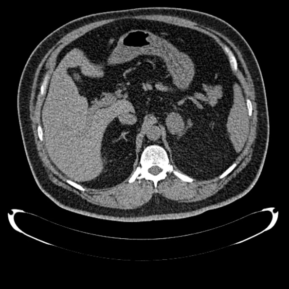 Bosniak renal cyst - type IV (Radiopaedia 24244-24518 Axial non-contrast 123).jpg