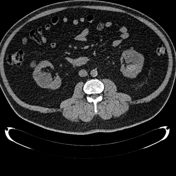 File:Bosniak renal cyst - type IV (Radiopaedia 24244-24518 Axial non-contrast 159).jpg