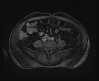 File:Bouveret syndrome (Radiopaedia 61017-68856 Axial T1 C+ fat sat 67).jpg