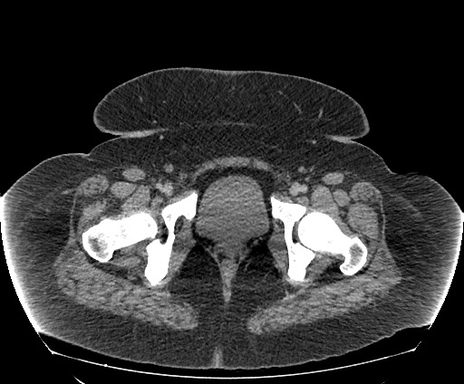 Bowel and splenic infarcts in acute lymphocytic leukemia (Radiopaedia 61055-68913 A 121).jpg