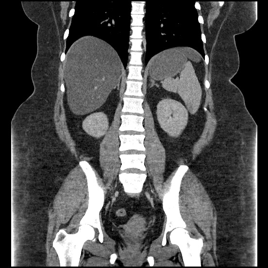 File:Bowel and splenic infarcts in acute lymphocytic leukemia (Radiopaedia 61055-68913 B 40).jpg